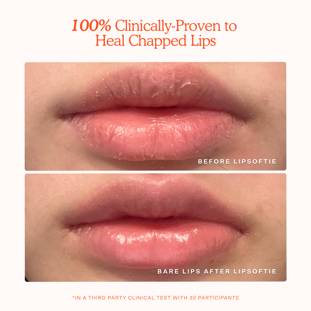 LipSoftie® Lip Treatment S0