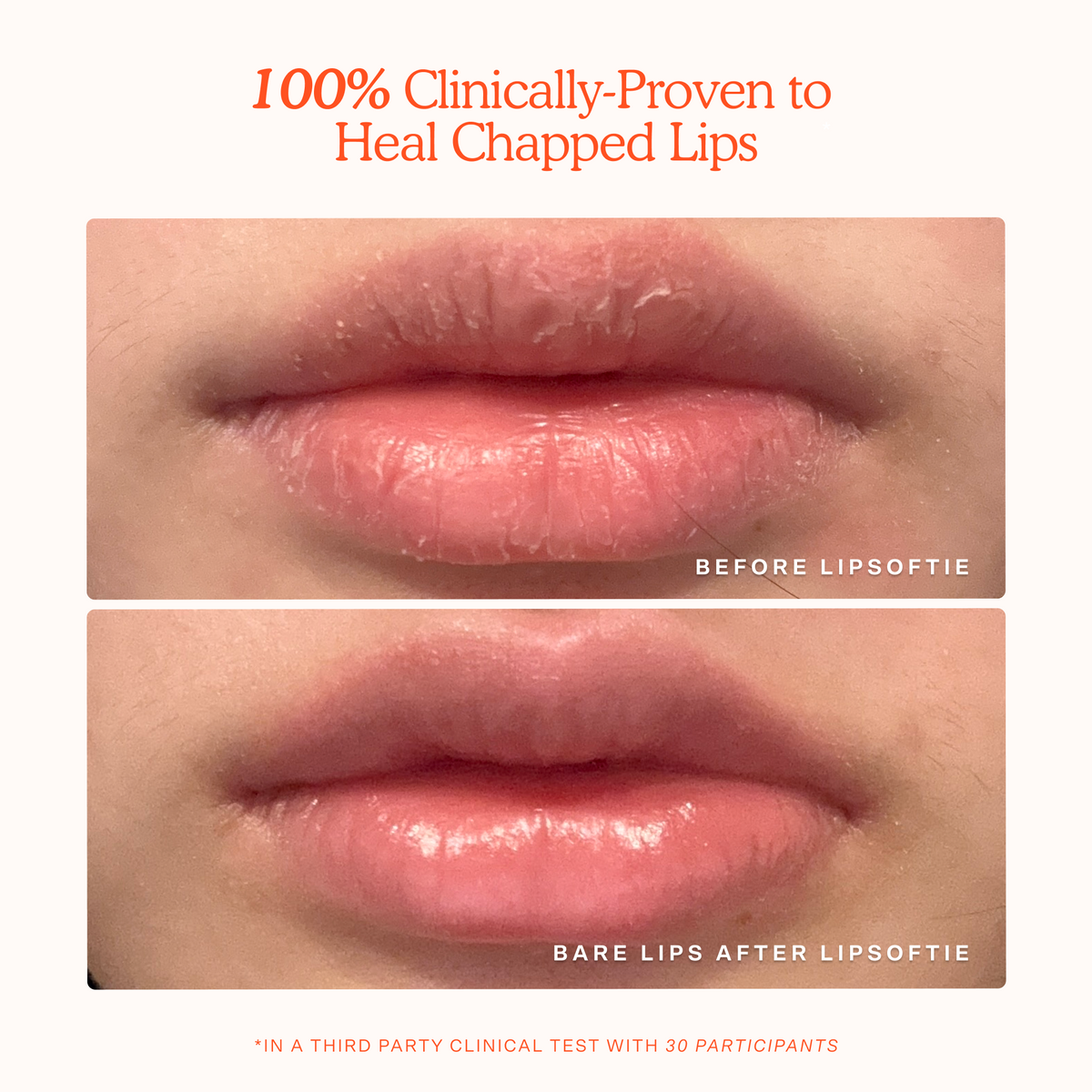 LipSoftie® Lip Treatment S0
