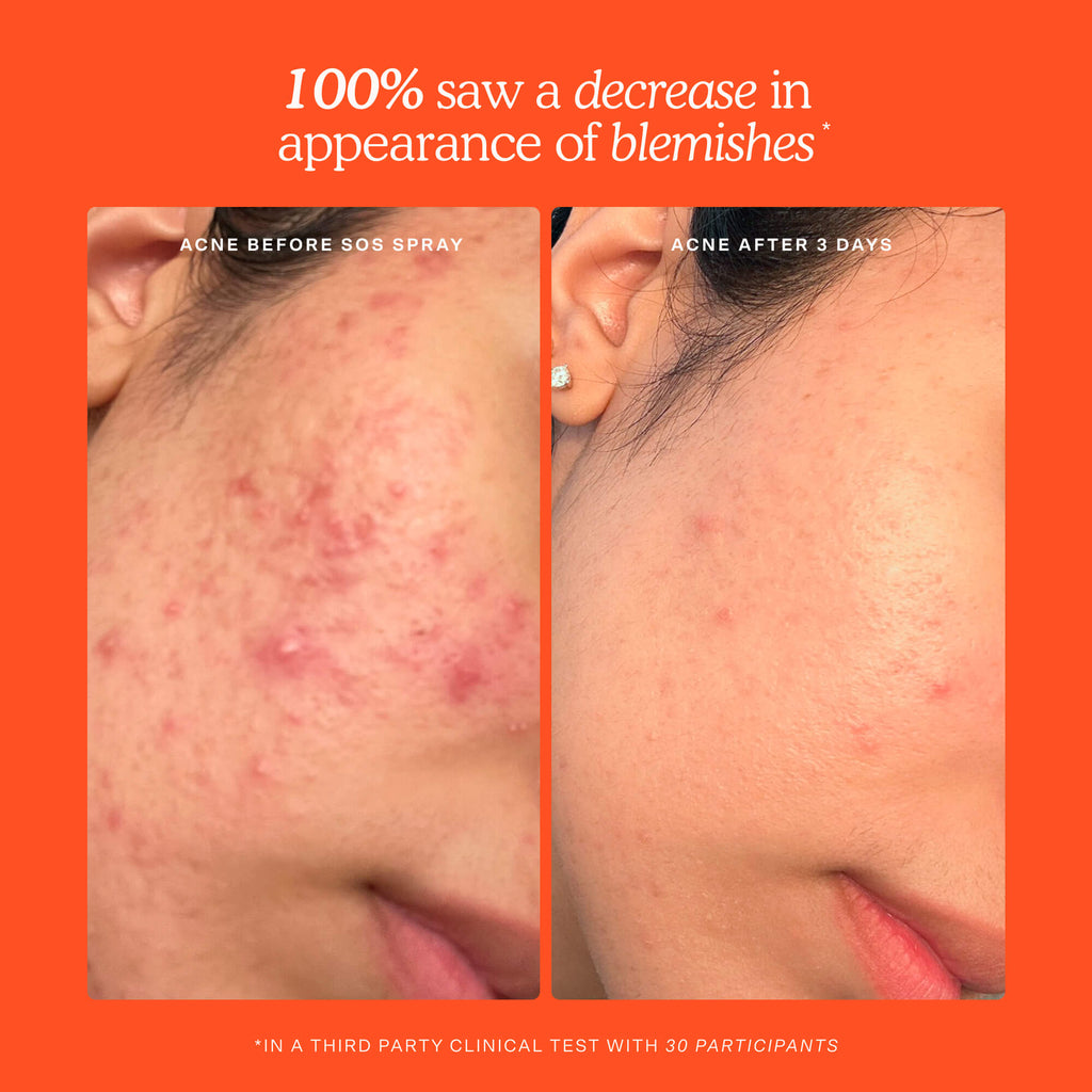 SOS Skincare Minis Kit H4