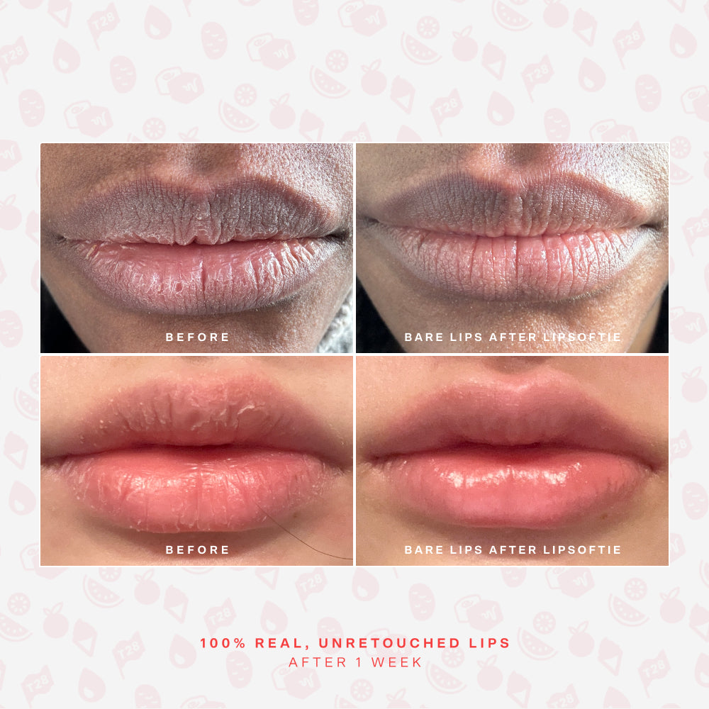 LipSoftie® Lip Treatment Set E5
