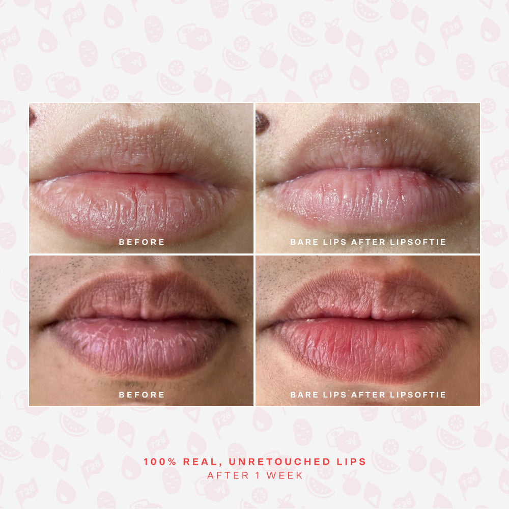 LipSoftie® Lip Treatment Set E5