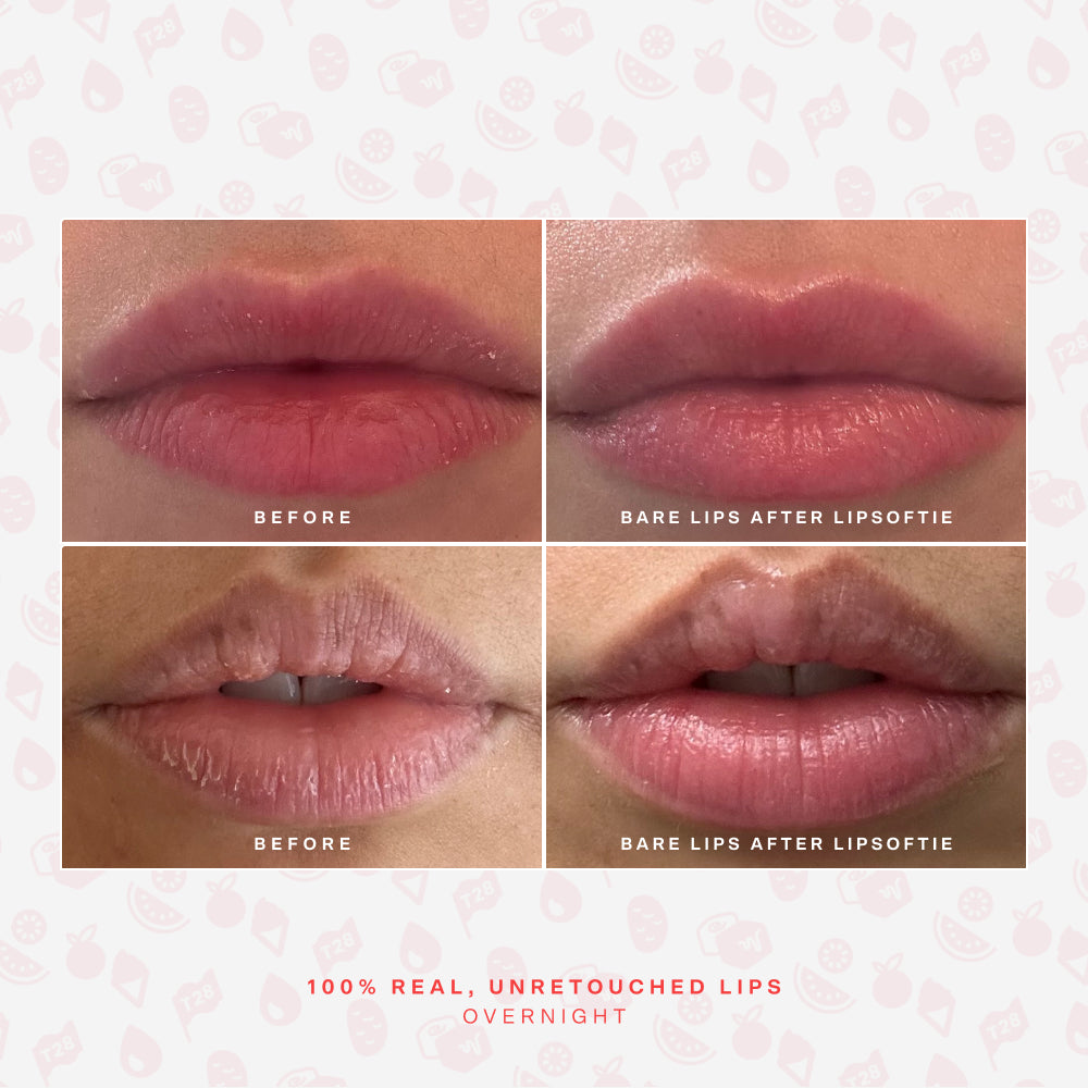 LipSoftie® Lip Treatment Set E5